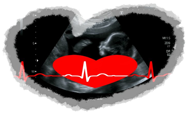 Heartbeat Bill - Abortion Ban